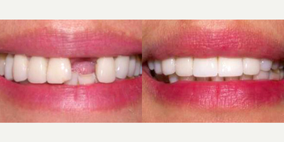 Dental Crown - 40 year-old woman lost her front tooth in a car accident. She also chipped her other front tooth. Dr. Steven Davidowitz inserted an esthetically positioned dental implant to replace her lost tooth. Both front teeth were restored with Porcelain crowns.