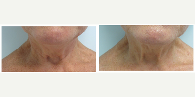 55-64 year old woman treated with Infini RF - Female patient treated with Infini to improve the look of the skin in the neck area.