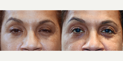 47 year old woman treated with Ptosis Surgery - Ptosis surgery in to correct your upper eyelid droopiness, improving vision and improving overall appearance.Procedure done to both upper eyelids.
