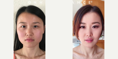 Woman treated with Cheekbone Reduction - Woman treated with Cheekbone Reduction