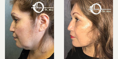 Woman treated with Neck Lift - Neck lift and transconjunctival blepharoplasty (eye surgery)