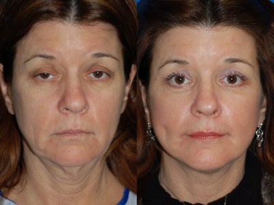 Quick Lift, Female - 
	Quick Lift, Female
