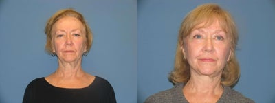 Facelift and upper/lower eyelid surgery - Patient had a facelift to correct loose skin on her neck and jowls.  At the same time she also had her upper and lower eyelids, &nbsp;6 months post op