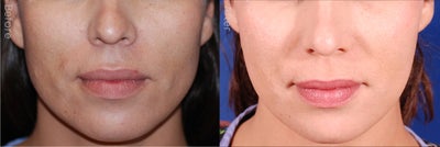 Mandibular Feminization - Mandibular angle osteotomies and chin countouring were performed to soften the angles of the jaw and give this patient a more feminine heart shaped appearance.  All incisions were made through the mouth.