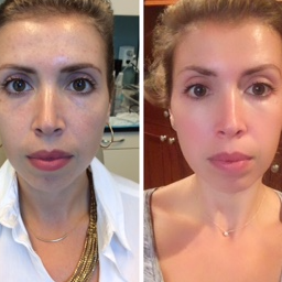 25-34 year old woman treated with Clear & Brilliant - This patient was treated with Clear & Brilliant for melasma and sun damage. She was put on a regimen of Lytera 2.0 twice daily with sunscreen usage in the morning.