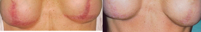 Breast implant scar removal - 
	Patient&#39;s breast implant scar before and after VBeam laser treatments.
