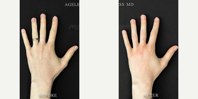25-34 year old woman treated with Renuva - 3ML Renuva for the Hands