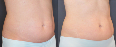 45-54 year old woman treated with UltraShape - Belly treated with UltraShape Power - series of 3 treatments. After this series she came back for a series on her flanks.&nbsp;