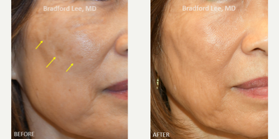 65-74 year old woman treated with Skin Rejuvenation, PicoSure - This patient had 3 sessions of Picosure Laser to remove her brown spots! Although patients can see results after 1 session, we recommend 3 for the best results.