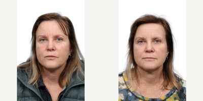 Woman treated with Ultralase, Vbeam - Woman treated with Ultralase, Vbeam