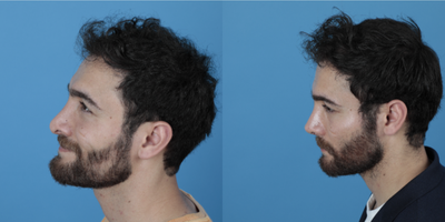 25-34 year old man treated with Revision Rhinoplasty - 20 days after revision Rhinoplasty what a great change he get