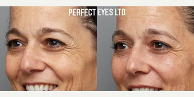 Woman treated with Dermal Fillers - Woman treated with Dermal Fillers