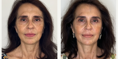 55-64 year old woman treated with Dermal Fillers, Skin Rejuvenation, Mesotherapy, Botox - skin rejuvenation