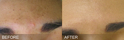 Woman treated with HydraFacial - Woman treated with HydraFacial