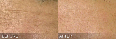 Woman treated with HydraFacial - Woman treated with HydraFacial