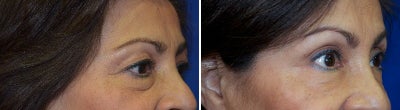 45-54 year old woman treated with Restylane - Restylane dermal filler to eye trough