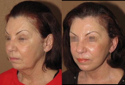 Face, neck lift - 
	complex face. necklift procedure
