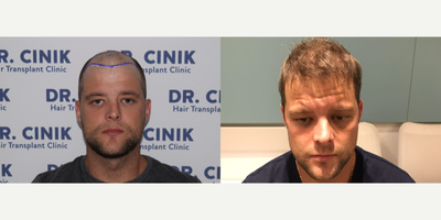 25-34 year old man treated with FUE Hair Transplant - 29 years oldNorwood 54000 graftsNatural hair line design, micro FUE techniquePunch type 0.7single: 376, double: 1622triple: 1425multiple: 327BEARD: 250