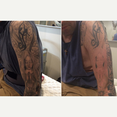 25-34 year old woman treated with Enlighten - After 1 Enlighten Tattoo Removal Laser Treatment. Client had not tried any other tattoo removal laser prior.