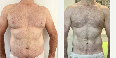 45-54 year old man treated with Vaser Liposuction - Before and after comparison of VASER Mid-Definition on the abdomen by Dr. Comins, showcasing the detailed sculpting achieved. This method subtly refines the abdominal contours, demonstrating the precision of Dr. Comins' surgical techniques combined with VASER technology.