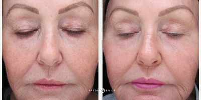 55-64 year old woman treated with Cosmelan - This is a 60-65 year old woman who received Cosmelan and facial fillers one month post procedure.
