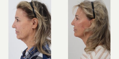 65-74 year old woman treated with Facelift, Neck Lift, TCA Peel - 71 year old 6 months post deep plane facelift, neck lift & TCA Jessner Peel by Dr. Dilip D. Madnani, MD FACS.
