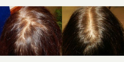56 year old woman treated with PRP for Hair Loss, Exo-Xom, FUE Hair Transplant - 56 year old woman treated with PRP for Hair Loss, Exo-Xom, FUE Hair Transplant