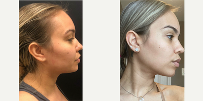 25-34 year old woman treated with Chin Liposuction, Buccal Fat Removal - 32 y.o female who underwent facial slimming surgery which includes chin liposuction and buccal fat removal.She was awake yet comfortable for the procedure