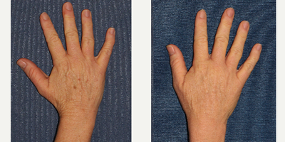 45-54 year old woman treated with Photodynamic Therapy - Woman treated with PDT for brown spots on her hands.