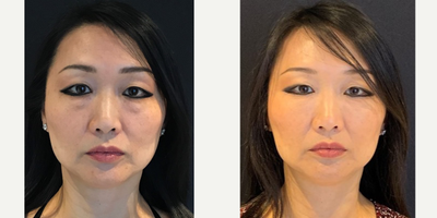 45-54 year old woman treated with Dysport - My 53 year old patient 2 weeks post Belotero and Dysport in the under eye area, as well as Dysport in the glabella lines and forehead and 1 syringe of Restylane Lyft in her cheeks. She also had a HydraFacial to imrpove the texture and tone and add hydration into the skin.