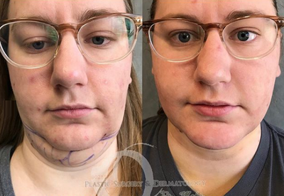 Woman treated with Liposuction - Woman treated with Liposuction