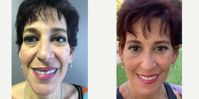 45-54 year old woman treated with ALMI - Before and 2 weeks after and ALMI/ SCEFI fat transfer.