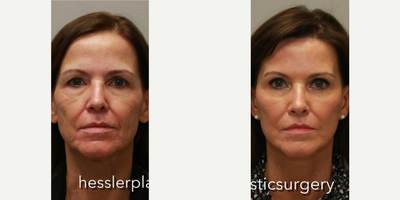 Woman treated with Cheek Augmentation - Woman treated with Cheek Augmentation through Facial Fat Transfer as well as Deep Plane Facelift, Neck Lift, Eyelid Surgery, and Brow Lift. Patient felt her face was looking tired and not matching her energy and vitality. She did not want temporary fixes wit injectable but was seeking a more permanent result.