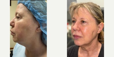 Woman treated with Ultherapy, Dermal Fillers - Look at the improvement & lifting of the upper eyelids Non-surgical laser, Ultherapy & fillers!