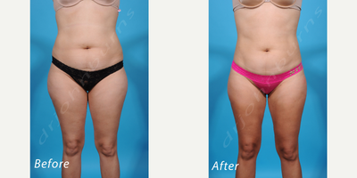 25-34 year old woman treated with Laser Liposuction - Laser Assisted Liposuction of Abdomen, Flanks, Thighs