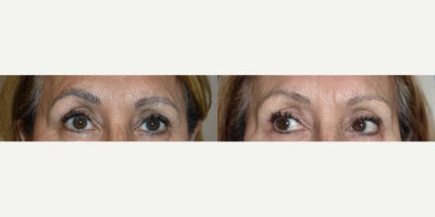 Los Angeles permanent makeup removal eyebrows - This patient came in to see us one year post laser treatment for permanent makeup removal of the eyebrows.  Only one treatment!  She was happy to get back to her old eyebrows only.