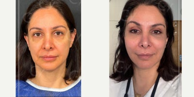 45-54 year old woman treated with Mini Facelift - 45-54 year old woman treated with Mini Facelift