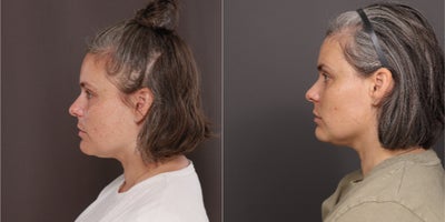 35-44 year old woman treated with Moxi Laser - Moxi Laser Treatments, 5 sessions with Katherine. 2 years post treatment, Age 39.