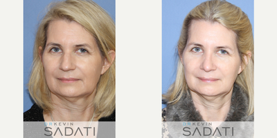 Septo-Rhinoplasty on 55 Yr Old Orange County Female - Septo-Rhinoplasty on 55 Yr Old Orange County Female
