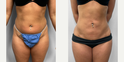 25-34 year old woman treated with Butt Lift, Liposuction - This woman in her early thirties met with Dr. Howell to discuss her interest in body contouring.  SmartLipo to the abdomen, flanks and saddle bag areas along with BBL fat injections to the lateral buttocks would help her achieve her desired appearance while being a less invasive option for surgery. She has nice contours to her abdomen, flanks and buttocks and is pictured before and three months after surgery.