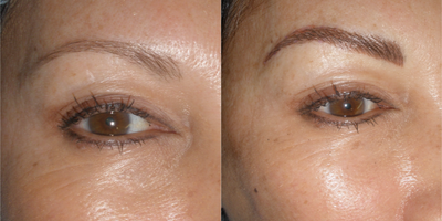 35-44 year old woman treated with Permanent Makeup - Patient desired the convenience of permanent makeup, so with the innovation of microblading to create natural hair strokes she has beautiful eyebrows now at any time