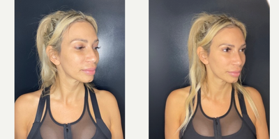 35-44 year old woman treated with Dermal Fillers - 1 syringe of RHA Redensity to soften the nasolabial folds.