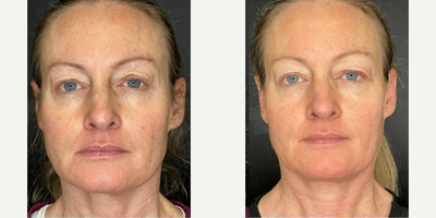 Woman treated with Scar Removal, Laser Scar Removal - Woman treated with Scar Removal, Laser Scar Removal