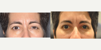 35-44 year old woman left Upper Eyelid Ptosis Repair - 35-44 year old woman left upper eyelid ptosis repair