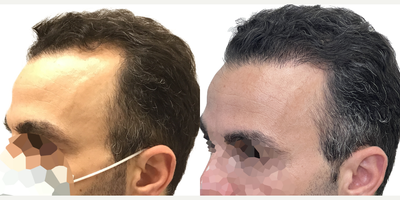38 year old man treated with Rogaine - This is a 38-year old male with progressive, androgenetic hair loss starting at about age 18. He was on finasteride for about 10 years when it first started but stopped at about age 28 because he just felt that he didnt want to be on oral medication anymore. Unfortunately, though, once he stopped the finasteride, his hair started falling out.More recently hed started daily minoxidil which was working well to prevent any more hair loss, but as expected, it didnt do anything to regrow the deepening recessions on both sides of his hairline. He was seeking restoration with surgery. You can really see those recessions once we shaved his head just prior to getting started. At the same time, he wanted a little more density behind his hairline in the frontal scalp, as well as a few grafts scattered over the crown, just to add a slight bit of density there.He had a 2461 graft FUE, with most of the grafts allotted to filling those recessions on either side of his hairline. We also added a few through the remainder of the frontal scalp and just a small amount in the crown.Hes had a great result! The recessions are restored and his hairline looks really natural! Hes still using his daily minoxidil to prevent ongoing hair loss and this is the kind of restoration that will age with him really naturally for decades to come. Even though we extracted more than 2400 grafts, weve done it in such a way that his donor area still looks really full. Youd really never be able to tell that this patient had a hair transplant!
