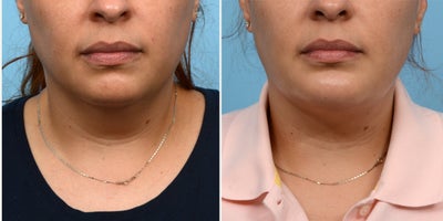 35-44 year old woman treated with Chin Implant - A double chin and inadequate projection were the reasons this 37-year-old patient sought out Dr. Wise. Seven weeks after her combination chin implant/ submental liposuction surgery, she absolutely loves the definition and contour of her new jawline!