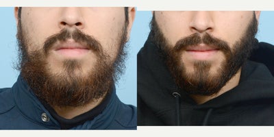 18-24 year old man treated with Beard Transplant - No more patchy beard for this 24 year old patient! He received an FUE Transplant of 2000 grafts, divided between both cheeks to fill in the patches in his beard. 11 months post-op, he is happy with the fullness and growth of his facial hair.