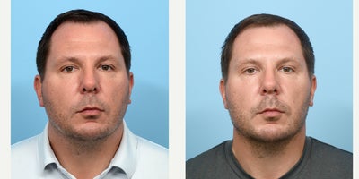 35-44 year old man treated with Chin Filler - Chin and jawline filler with Dr. Wise