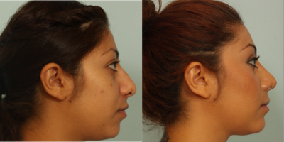 25-34 year old woman treated with Rhinoplasty - Primary Rhinoplasty with Chin Augmentation