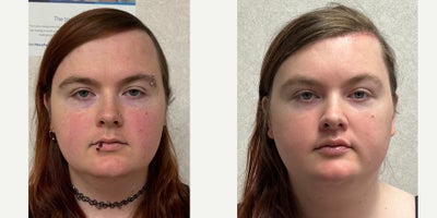 25-34 year old woman treated with Brow Bone Reduction, Forehead Reduction, Brow Lift, Facial Feminization Surgery, Lip Lift, Lip - this is a young lady who underwent forehead feminization, chin feminization, and lip surgery.